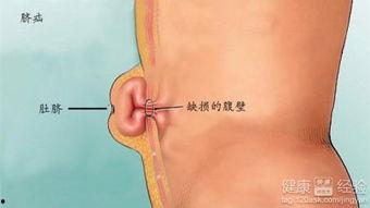 成人脐疝手术图片视频,图片与视频详解