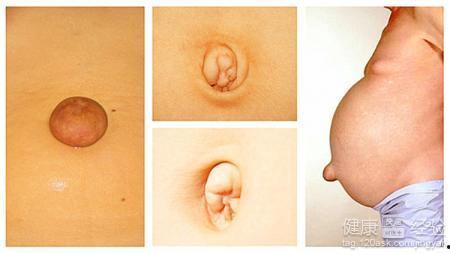 成人脐疝手术图片视频,图片与视频详解